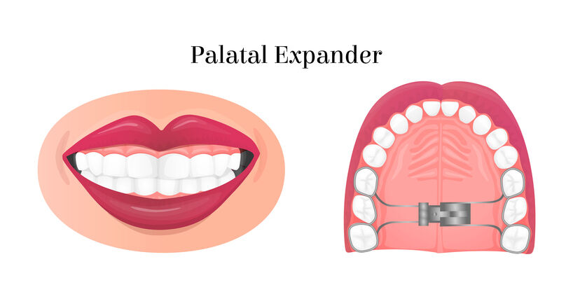 palatal-expanders